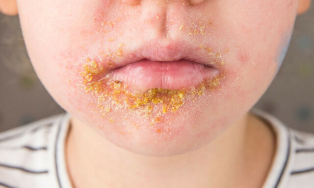 BRENNKOPPER: Utslett lokalisert rundt munnen i dette tilfellet. Dette kan likne på perioral dermatitt, men man finner honninggule skorper, og dette skyldes en bakterieinfeksjon. FOTO: NTB Scanpix / Shutterstock BRENNKOPPER: Utslett lokalisert rundt munnen i dette tilfellet. Dette kan likne på perioral dermatitt, men man finner honninggule skorper, og dette skyldes en bakterieinfeksjon. FOTO: NTB Scanpix / Shutterstock